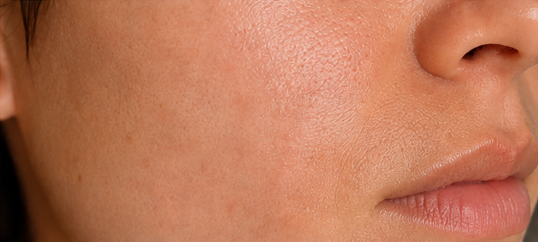 Après nanoneedling — imperfections nettement réduites
