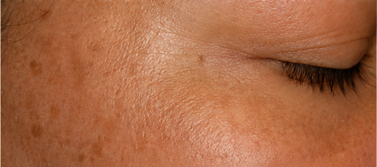 Avant nanoneedling — taches pigmentaires et teint irrégulier