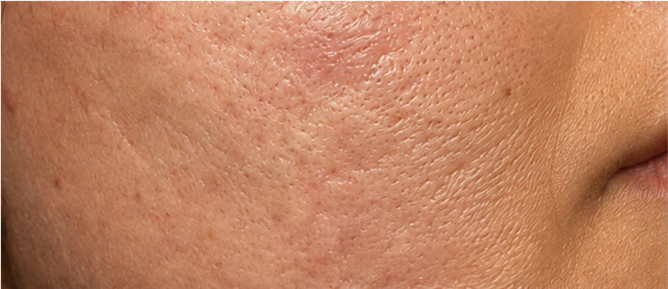 Avant nanoneedling — texture marquée et cicatrices
